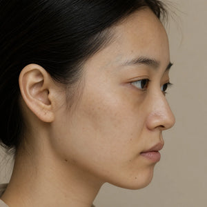 Skin Dullness skin concern - Xovive exosome treatment
